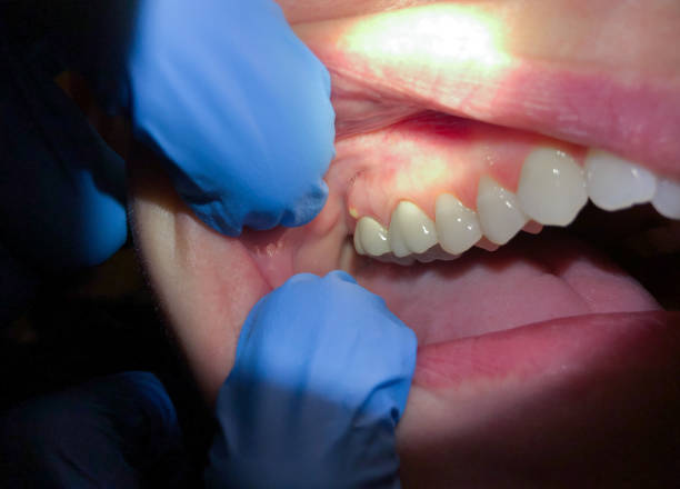 Best Cracked Tooth Emergency Dentist  in Lantana, FL